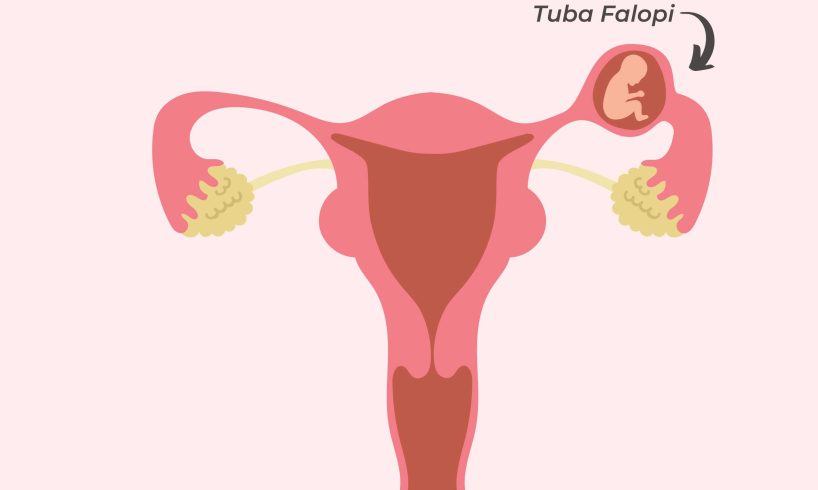 Kehamilan Ektopik: Gejala, Risiko, dan Penanganannya